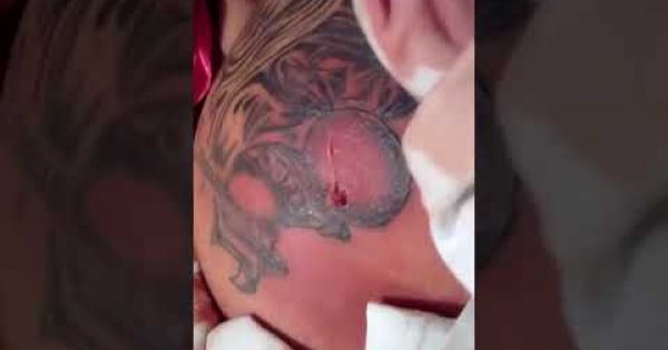 Eine Ziemlich Uble Infektion Eines Tattoos Webfail Fail Bilder Und Fail Videos